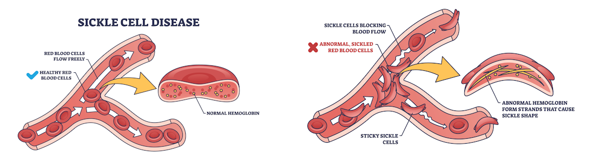 Oxbryta recall lawsuit for sickle cell treatment recall